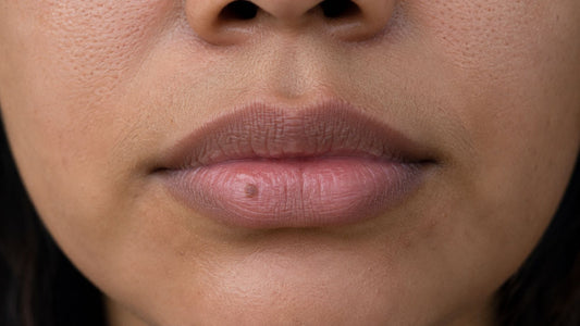 Brown Spot on Your Lip: What It Is, When to Worry, and How to Fade It
