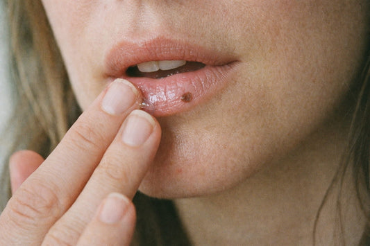 Brown Spot on Your Lip: What It Is, When to Worry, and How to Fade It