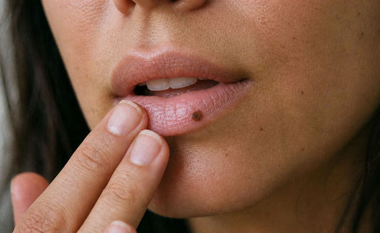 Lunares en los labios: qué son, cuándo preocuparse y cómo corregirlos